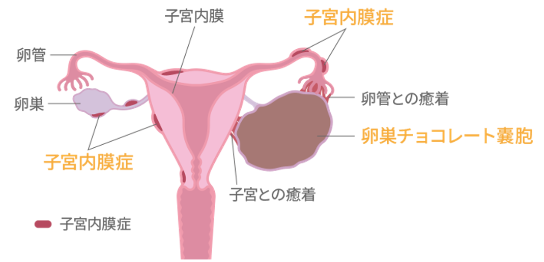 子宮内膜症・子宮腺筋症ー診断アトラス&新たな治療戦略 (産科